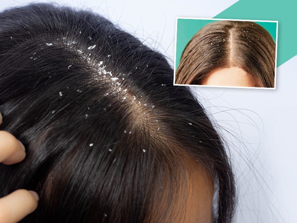 Learn how to identify the difference between dandruff and dry scalp.